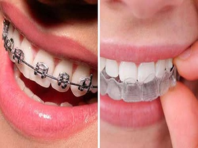 What Are Dental Braces?